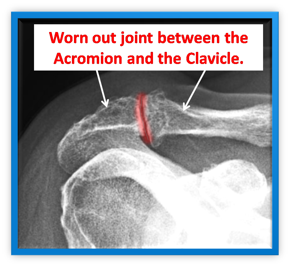 clavicularis osteoarthritis